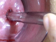 Insertion The Catheter In Cervix Women Mature