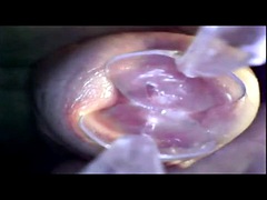 Endoscope in 2 spoons, penetration into the urethra, examination of the penis